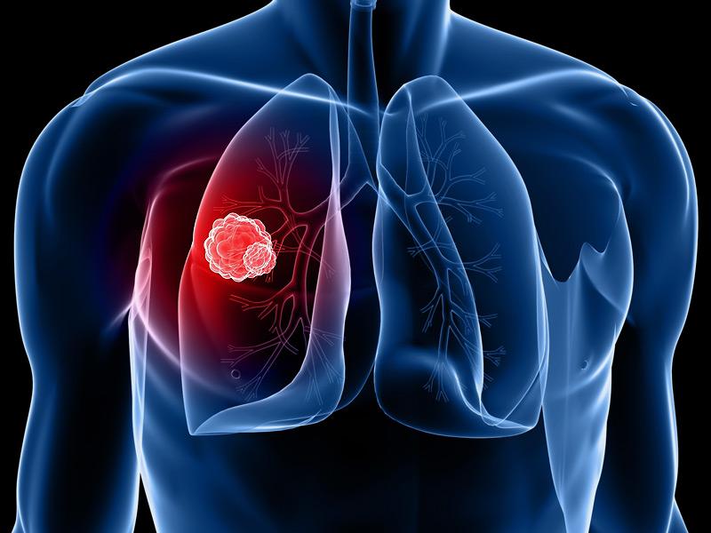 Életet mentett a magyar tüdőrákszűrő mobilalkalmazás